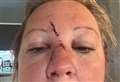 Woman suffers “horrific” injuries in random bar attack